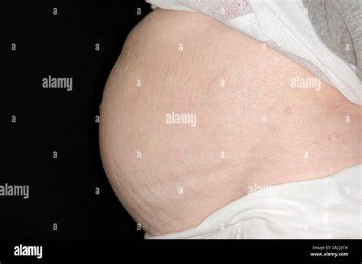 A woman with a distended stomach; with two dissected views of her