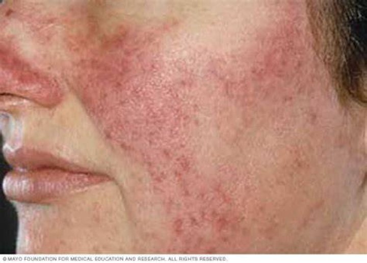 Barbara O&rsquo;Neill Skin conditions rosacea eczema psoriasis skin 