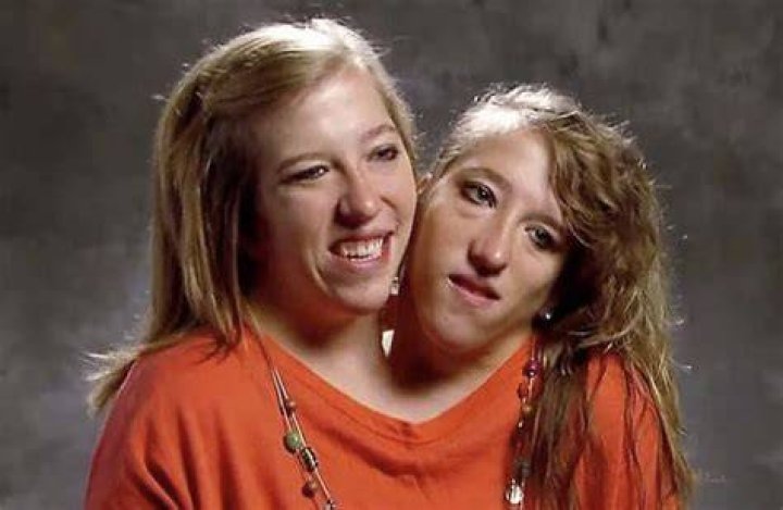 Conjoined Twins Abby and Brittany Hensel Posted Details About Their Sex