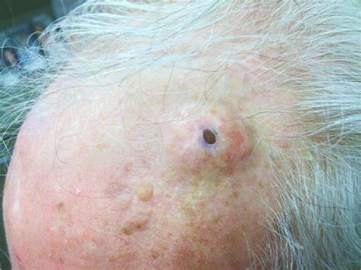 Gigantic Blackheads Dilated Pore of Winer Explained! The Pretty Pimple