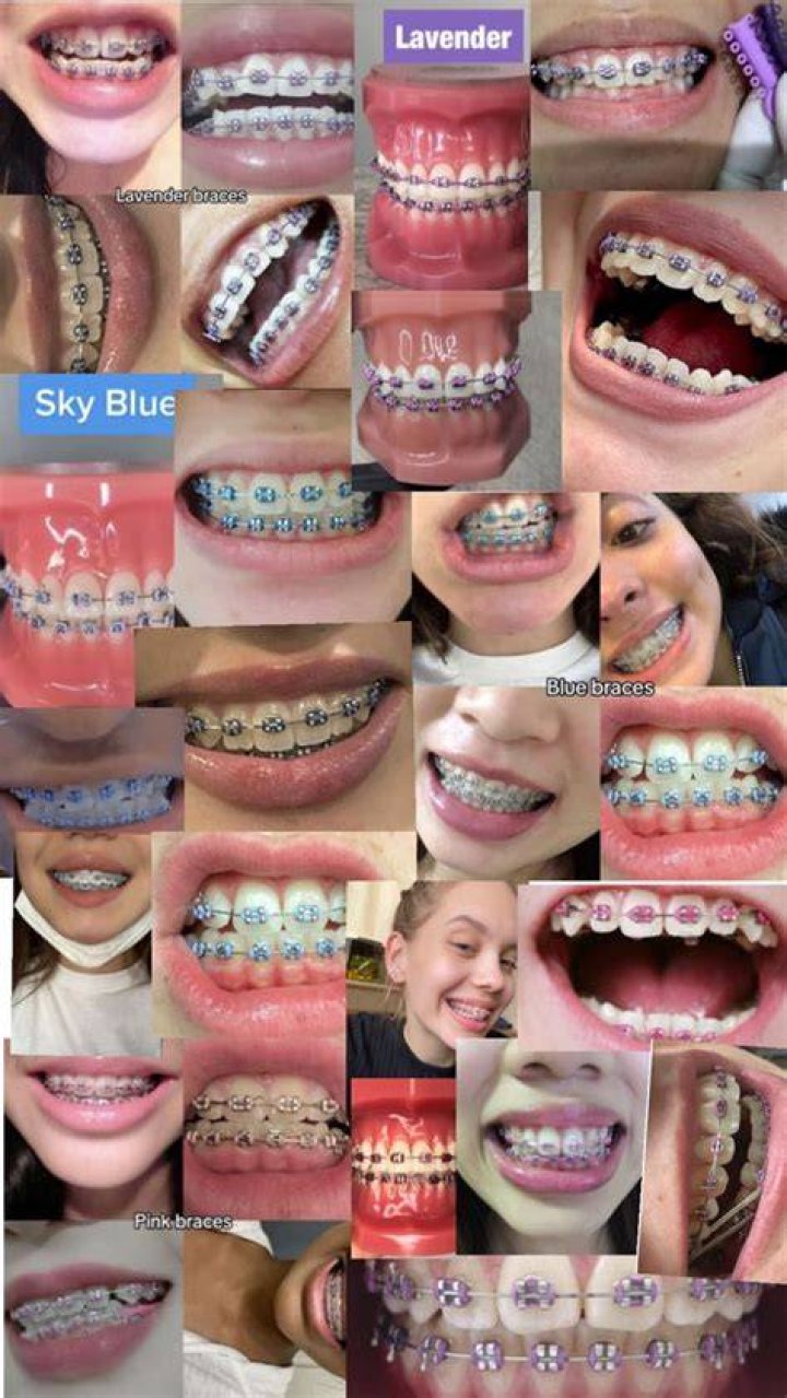 Girls With Braces Colors Girls With Braces Meninas de cabelos