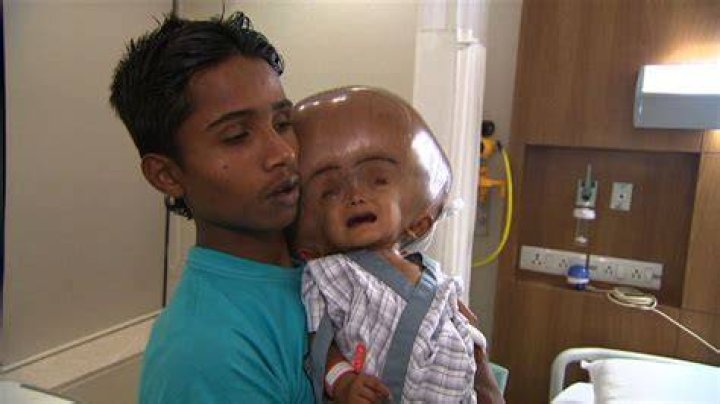 Indian child Roona Begum recovering after hydrocephalus surgery CNN