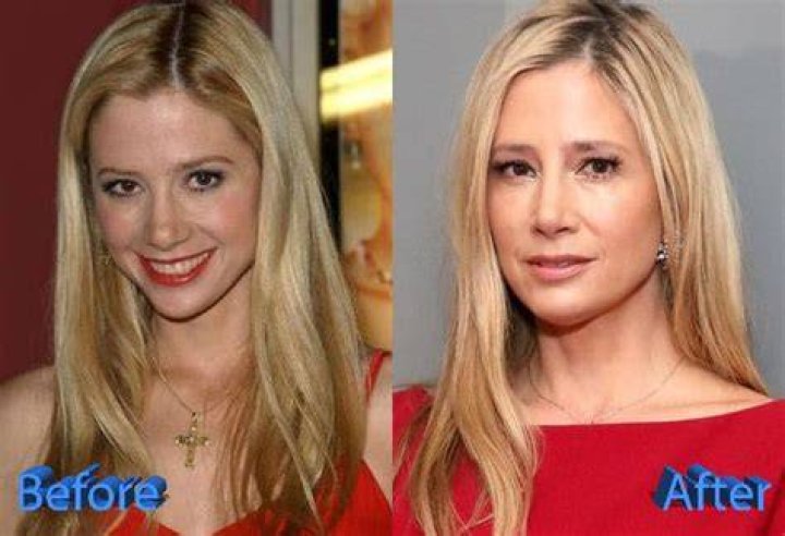 Mira Sorvino Before and After Plastic Surgery Plastic surgery