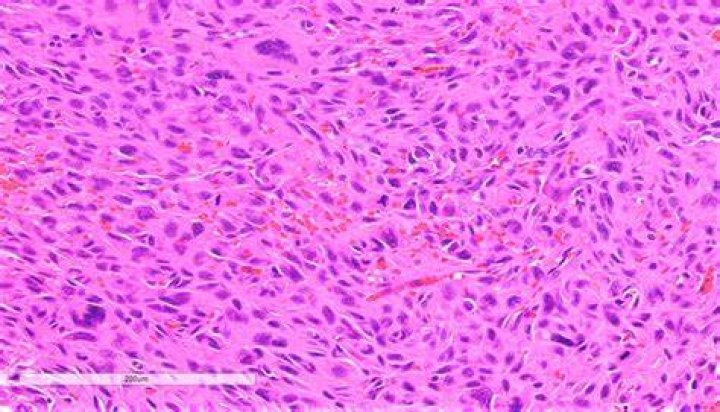 Pathology Outlines Atypical fibroxanthoma