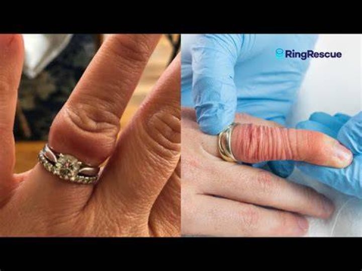 Ring Stuck On Finger? This Trick Could Save Your Finger And Your Ring