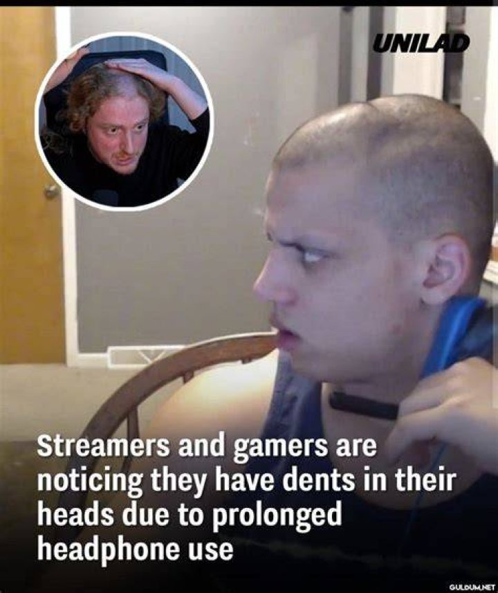 Streamers and gamers are noticing they have dents in their heads due to